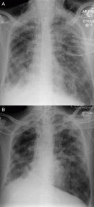 Chest X-ray of one of our international patients after receiving our cellular therapy and stem cells for COPD