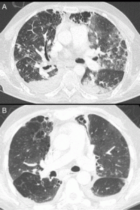 CT scan of one of our international patients after receiving our cellular therapy and stem cells for COPD