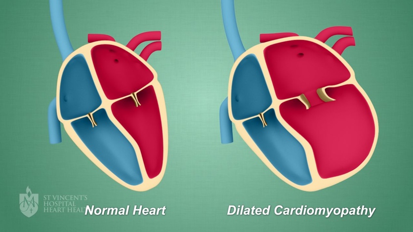 Cardiomyopathy is estimated to affect around 1 in every 500 individuals globally. 