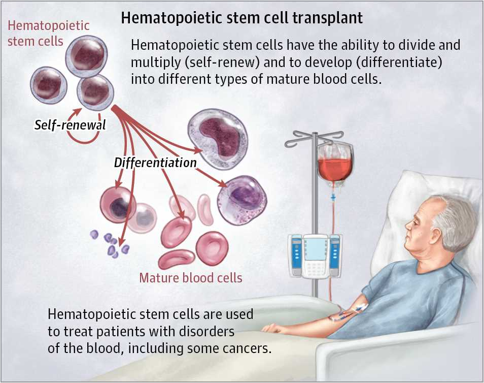 Hematopoietic stem cell transplantation (HSCT) is a medical procedure that involves the infusion of hematopoietic stem cells to restore normal blood cell production in patients with certain blood disorders. 