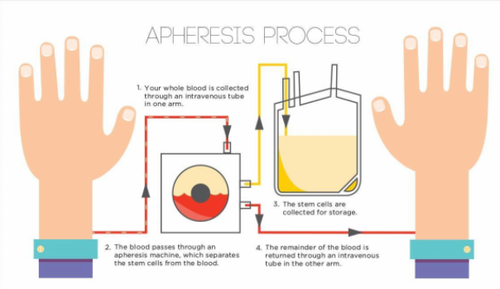 Apheresis is a medical procedure that involves the separation and removal of specific components from a person's blood while returning the remaining blood back to the individual. 