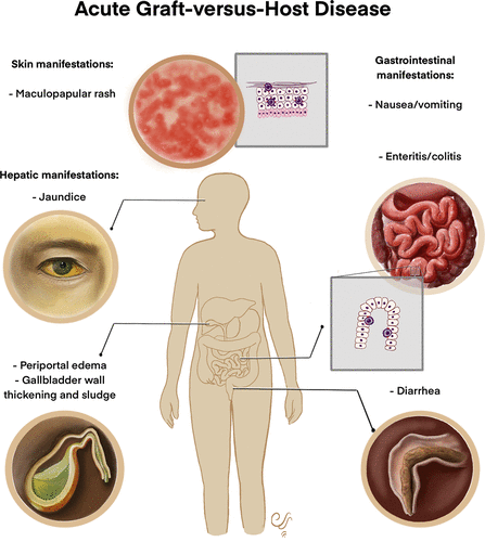 Graft-versus-host disease (GVHD) is a serious complication that can occur following an allogeneic stem cell transplant, where the donor's immune cells (the graft) recognize the recipient's body tissues (the host) as foreign and mount an immune response against them.