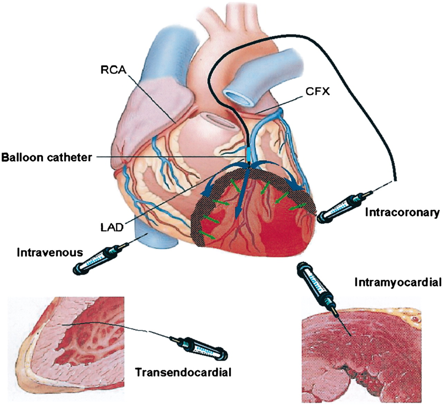  Intracoronary Infusion: Stem cells can be delivered through the coronary arteries using catheter-based techniques, enabling widespread distribution throughout the myocardium. 