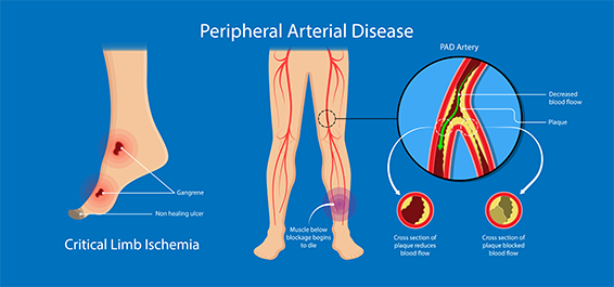  PVD, PAD, and chronic arterial occlusive disease of lower limbs collectively impact millions of individuals globally.