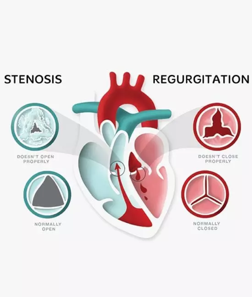 Valvular heart disease affects millions of people worldwide, with rheumatic heart disease being a significant contributor in developing countries.