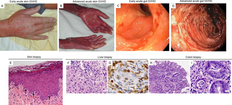 What is Graft vs. Host Disease (GvHD) and how does Dr. StemCellsThailand mitigate this risk? 