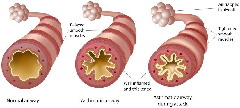 Preclinical studies have shown that mesenchymal stem cells (MSCs) can reduce airway inflammation and improve lung function in animal models of asthma.