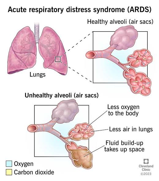 Cellular Therapy and Stem Cells for Lung Diseases contribute to ALI treatment by promoting lung regeneration, modulating immune responses, and repairing damaged lung tissue.