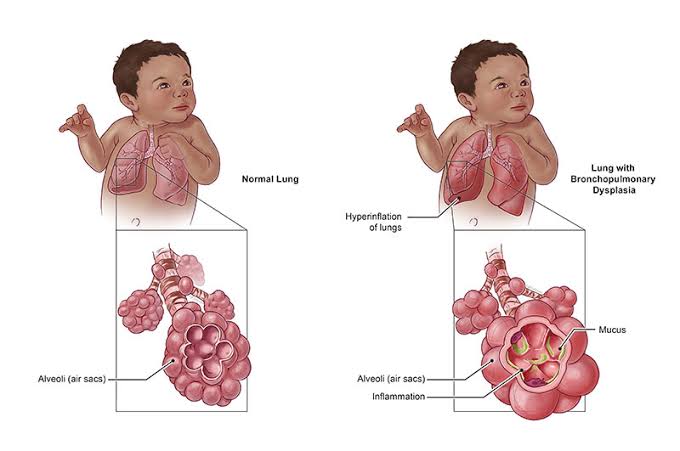 Preclinical studies using MSCs have demonstrated their ability to promote lung growth, reduce inflammation, and improve respiratory function in animal models of BPD.