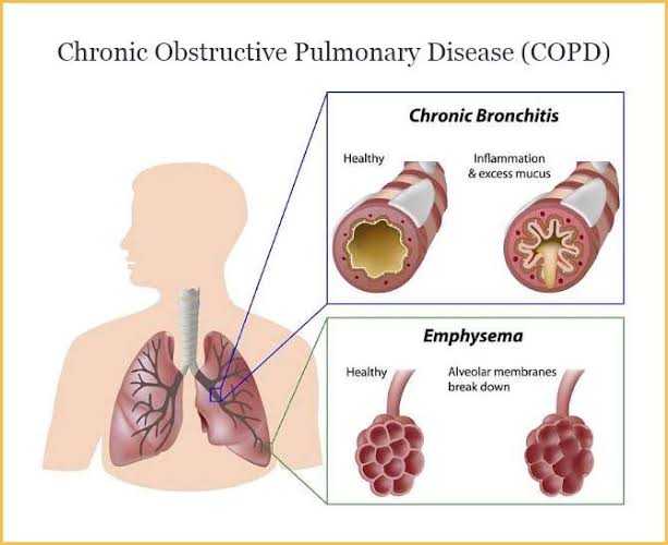 Early-phase clinical trials in COPD patients have demonstrated safety and potential efficacy of MSC therapy, with reports of decreased exacerbations and improved quality of life.