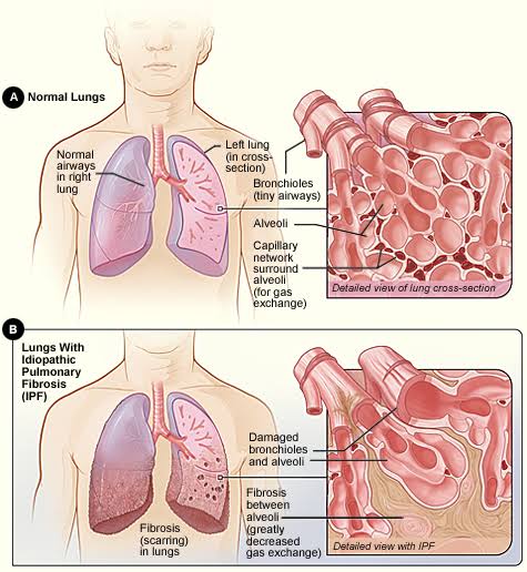 Cellular Therapy and Stem Cells for Lung Diseases may offer potential benefits in repairing lung damage, reducing inflammation, and improving respiratory function in individuals with occupational lung diseases.