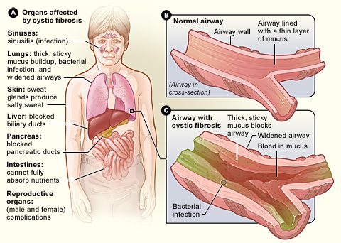 Cellular Therapy and Stem Cells for Lung Diseases offer potential avenues for CF treatment by addressing underlying genetic defects, promoting mucus clearance, and supporting lung tissue repair