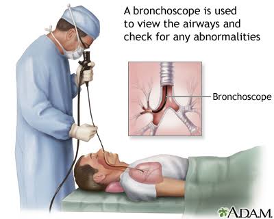 Endobronchial instillation involves introducing Cellular Therapy and Stem Cells  directly into the bronchial tree using a catheter or bronchoscope.