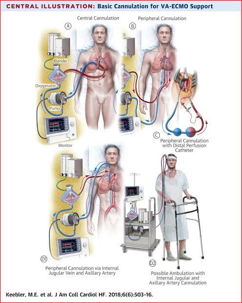 Cellular Therapy and Stem Cells can be delivered to the lungs via the ECMO circuit. The ECMO machine acts as an artificial lung