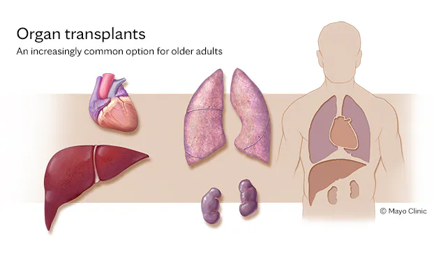 Solid Organ Transplantation: Although primarily associated with HSCT, HLA matching is also relevant for other types of transplants, such as kidney or liver, to ensure long-term transplant success.