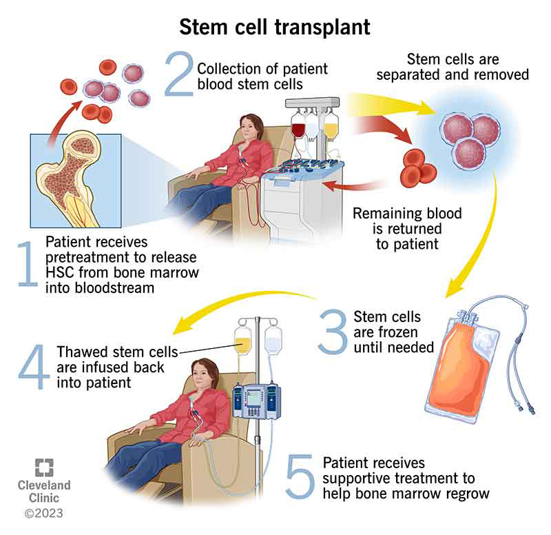 Blood disorders and cancers: Hematopoietic stem cell transplants are used to treat leukemia, lymphoma, and other blood diseases.