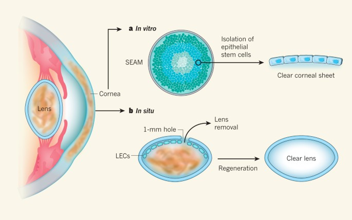 Limbal Cellular Therapy and Stem Cells transplants can restore vision in patients with corneal blindness caused by burns or other injuries.