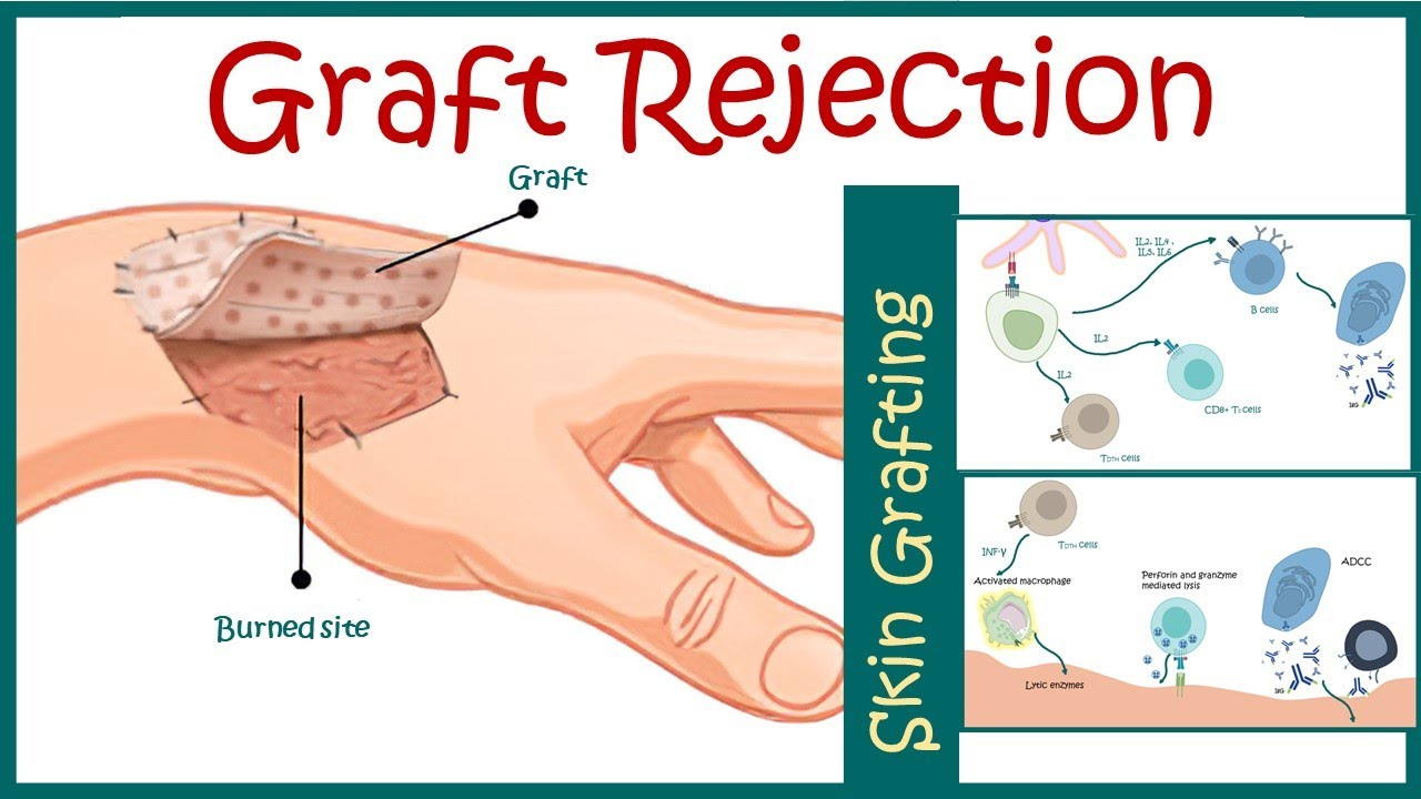 Prevents Graft Rejection: Proper HLA matching reduces the risk that the recipient's immune system will recognize the transplanted Cellular Therapy and Stem Cells as foreign and attack them.