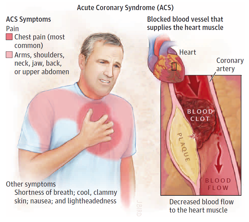 ACS affects millions of people worldwide each year, with approximately 1.5 million cases reported in the United States alone annually.