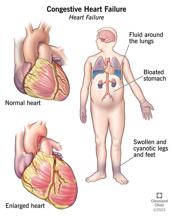 CHF is a prevalent condition worldwide, affecting over 26 million people globally.

