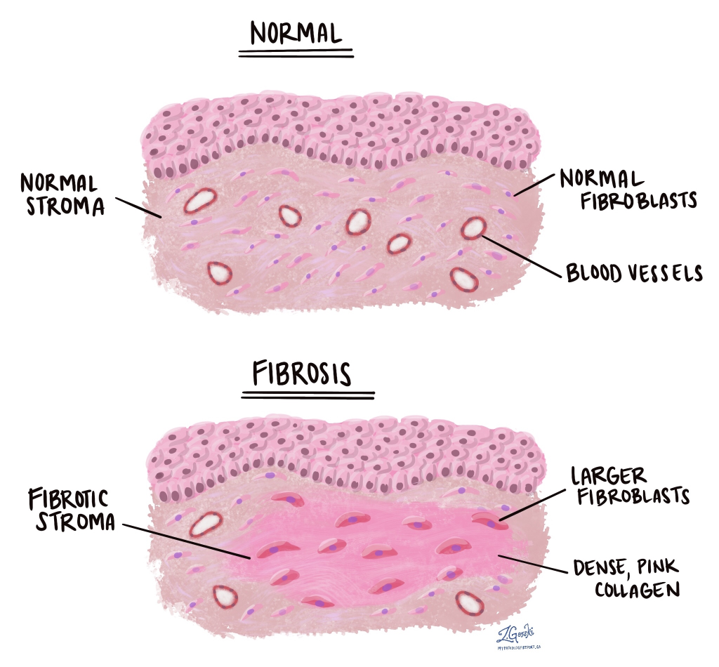 Fibrosis is a pathological condition characterized by the excessive accumulation of fibrous connective tissue, primarily collagen, in various tissues and organs.