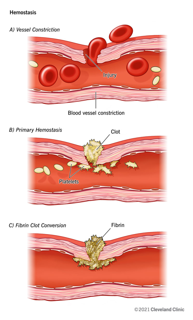 Hemostasis is the physiological process that prevents and stops bleeding, ensuring that blood remains within damaged blood vessels.