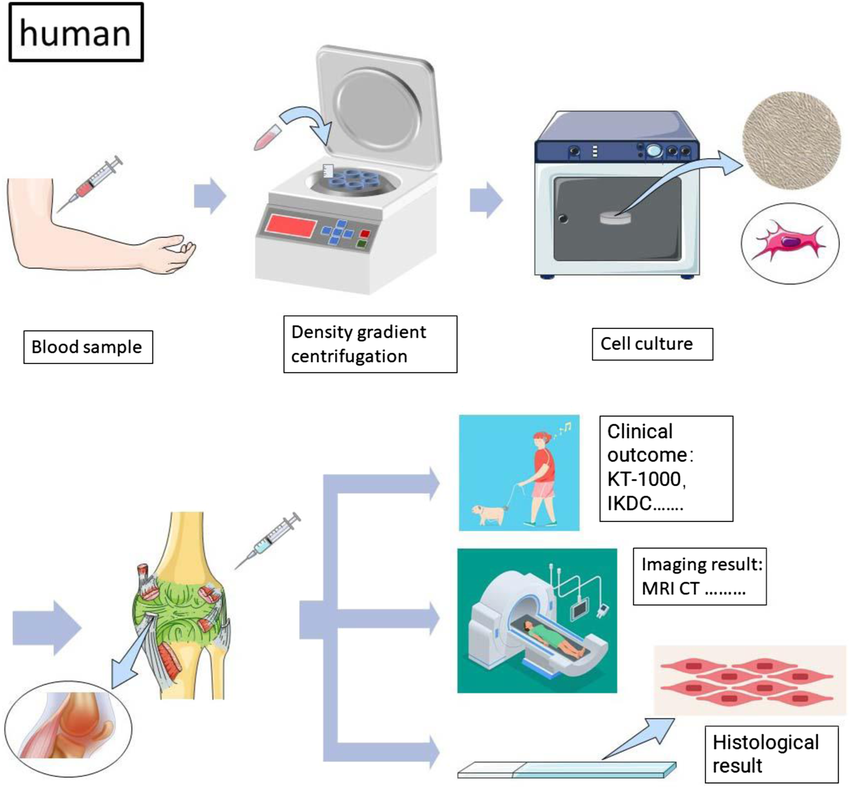 Peripheral blood stem cells (PBSCs) are hematopoietic stem cells that circulate in the bloodstream. They can be collected and used for various medical treatments, particularly in the context of stem cell transplantation.