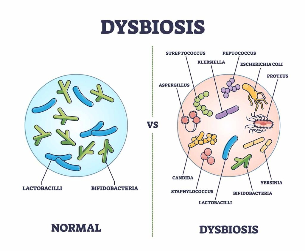 Dysbiosis refers to an imbalance in the microbial communities within the body, particularly in the gut microbiome.