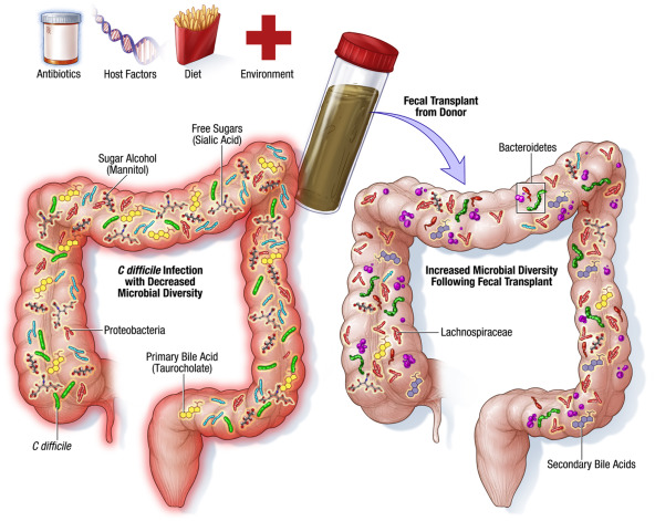 Fecal microbiota transplantation (FMT) is a medical procedure that involves transferring fecal matter from a healthy donor into the gastrointestinal tract of a recipient. 