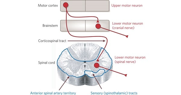 Degeneration of UMNs and LMNs contributes to muscle weakness, spasticity, muscle atrophy, weakness, and eventual paralysis. 