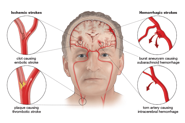 Cellular Therapy and Stem Cells for Brain, Spinal Cord and Neurodegenerative Diseases : Hemorrhagic Stroke