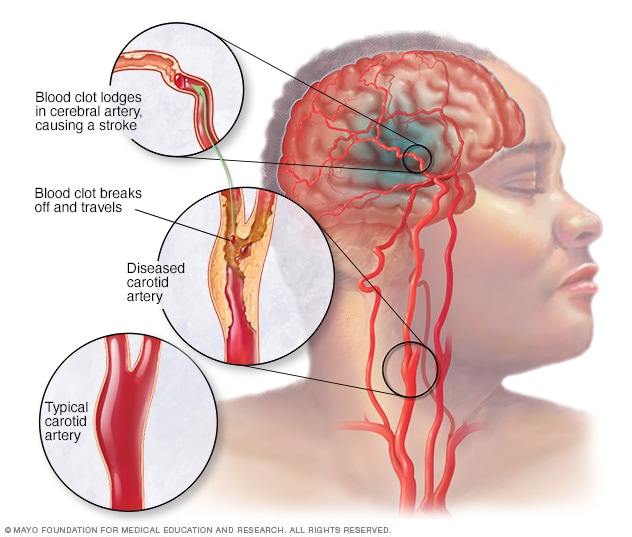 Cellular Therapy and Stem Cells for Brain, Spinal Cord and Neurodegenerative Diseases : Ischemic Stroke