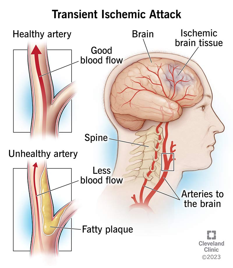 Cellular Therapy and Stem Cells for Brain, Spinal Cord and Neurodegenerative Diseases : Transient Ischemic Attack (TIA)