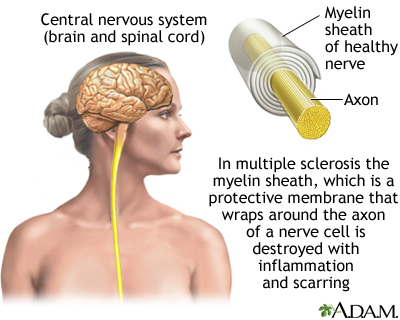 Cellular Therapy and Stem Cells for Brain, Spinal Cord and Neurodegenerative Diseases : Multiple Sclerosis