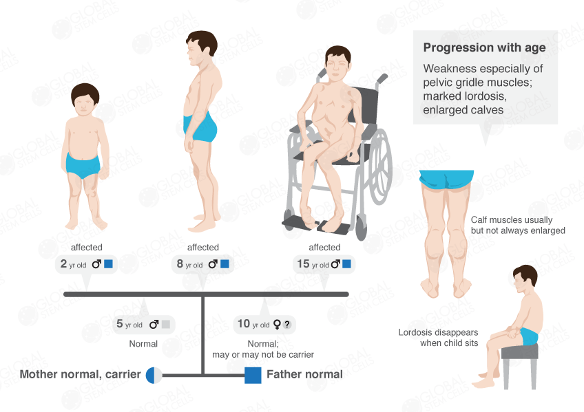 Cellular Therapy and Stem Cells for Brain, Spinal Cord and Neurodegenerative Diseases :  Muscular Dystrophy (MD)