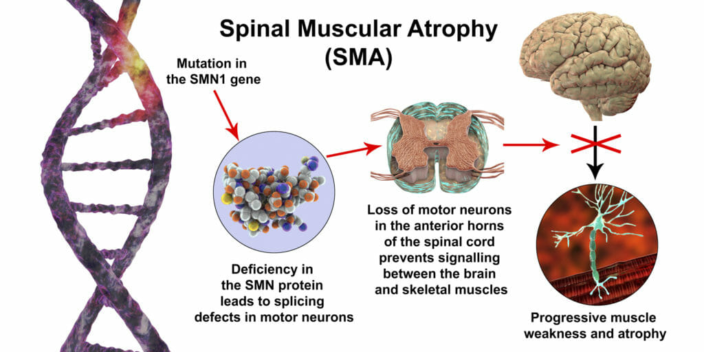 Cellular Therapy and Stem Cells for Brain, Spinal Cord and Neurodegenerative Diseases :  Spinal Muscular Atrophies (SMA)