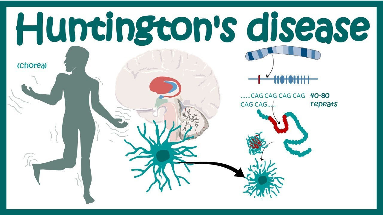 Cellular Therapy and Stem Cells for Brain, Spinal Cord and Neurodegenerative Diseases : Huntington's Disease