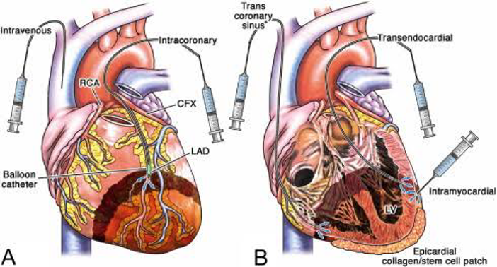 Our specialized treatment protocols for Coronary Artery Disease (CAD), Myocardial Infarction (MI), and Acute Coronary Syndrome (ACS) employ a dual delivery approach, utilizing both intravenous and intracoronary injections to maximize the therapeutic efficacy of Cell-based Therapies with Cardiac Progenitor Stem Cells and Growth Factors. 