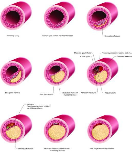 Coronary artery disease (CAD), ischemic heart disease (IHD), and acute coronary syndrome (ACS) progress through several stages, reflecting the severity of the disease and the extent of arterial blockage.