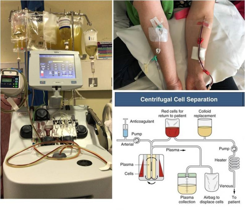 Plasmapheresis (PMPT), also known as therapeutic plasma exchange (TPE), is a medical procedure that involves the removal, treatment, and return of blood plasma from the circulation. 