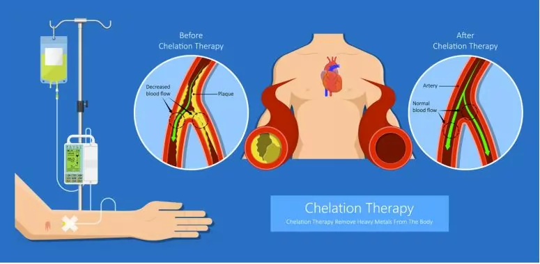 Chelation therapy is a medical treatment that involves the administration of chelating agents, such as ethylenediaminetetraacetic acid (EDTA), through intravenous (IV) infusion.