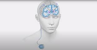 DBS involves implanting electrodes in specific brain areas to reduce motor symptoms by modulating brain activity, especially in patients not responding well to medication.