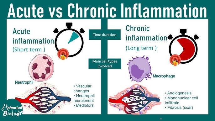 Inflammation (IFM) is a biological response of body tissues to harmful stimuli, such as pathogens, damaged cells, or irritants.