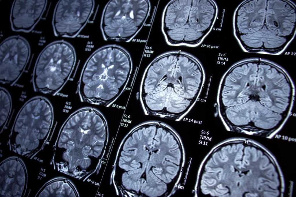 A Brain MRI (BMRI/ Brain Magnetic Resonance Imaging) is a non-invasive imaging test that uses powerful magnets and radio waves to create detailed images of the brain and surrounding tissues