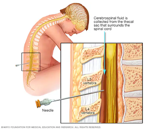 A Lumbar Puncture (LP), commonly known as a spinal tap, is a medical procedure where a needle is inserted into the lower back to collect cerebrospinal fluid (CSF) for diagnostic or therapeutic purposes.