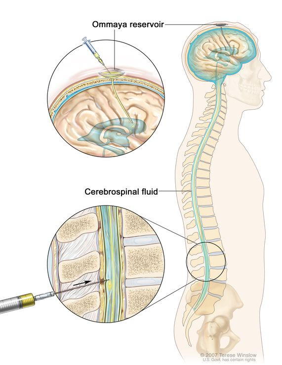 Intrathecal/Intraspinal Injection, also known as intraspinal injection, involves the administration of medication directly into the cerebrospinal fluid (CSF) within the intrathecal space of the spinal column. 