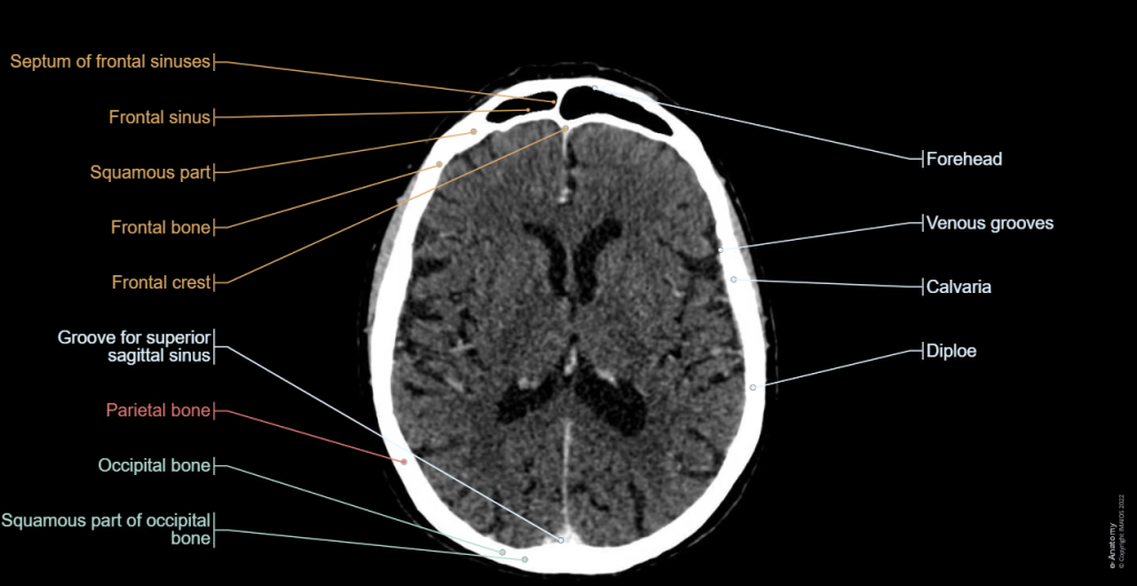 A CT scan of the brain, also known as a head CT or cranial CT, is a diagnostic imaging procedure that uses X-rays to create detailed cross-sectional images of the brain and surrounding structures. 