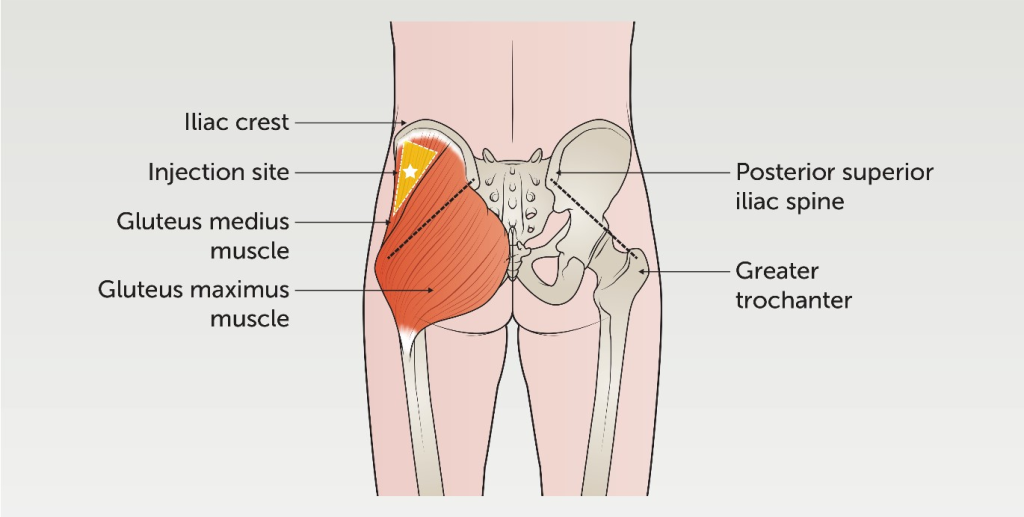 Intramuscular (IM) injection of cellular therapy and stem cells is a method used to deliver therapeutic cells directly into muscle tissue. 