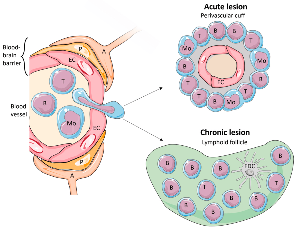 The pathogenesis of Multiple Sclerosis (MS) is driven by interactions between various central nervous system (CNS) cells and infiltrating immune cells. Here are the primary cells involved: