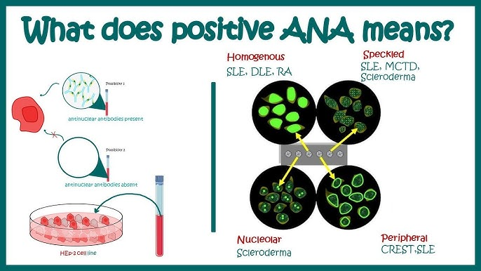 Antinuclear antibodies (ANA) are autoantibodies produced by the immune system that mistakenly target the body's own cells, specifically the nucleus. 